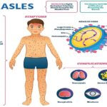 measles_cng